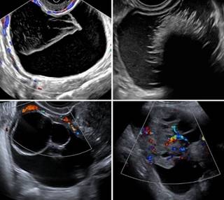 Ultrasound ORADS Images