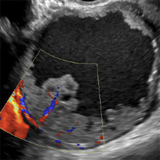 Ultrasounds ORADS Image