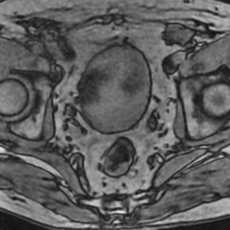 Prostate MRI scan image