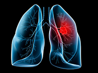 Lung cancer case study of a patient