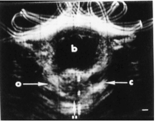 Grayscale sonogram showing the right ovary, left corpus luteum and bladder, circa 1974.